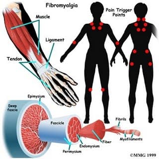 Fibromyalgia