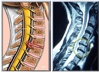 Disc Herniation